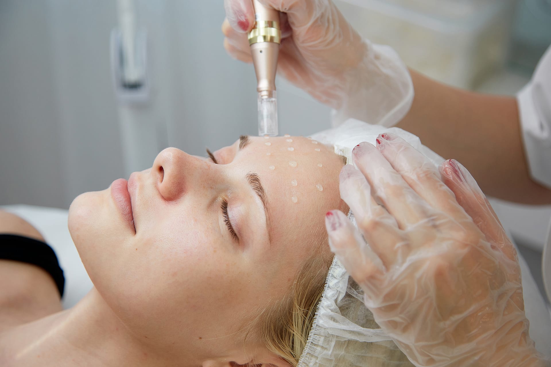 Microneedling